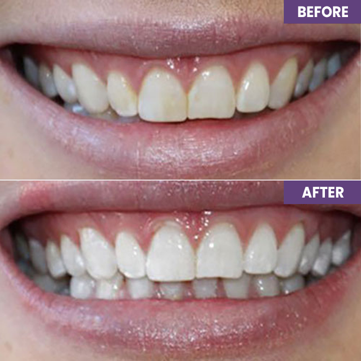 Last Day Discount ⏳LIMETOW™ Instant Teeth Whitening Paint: Smile Confidently🌟