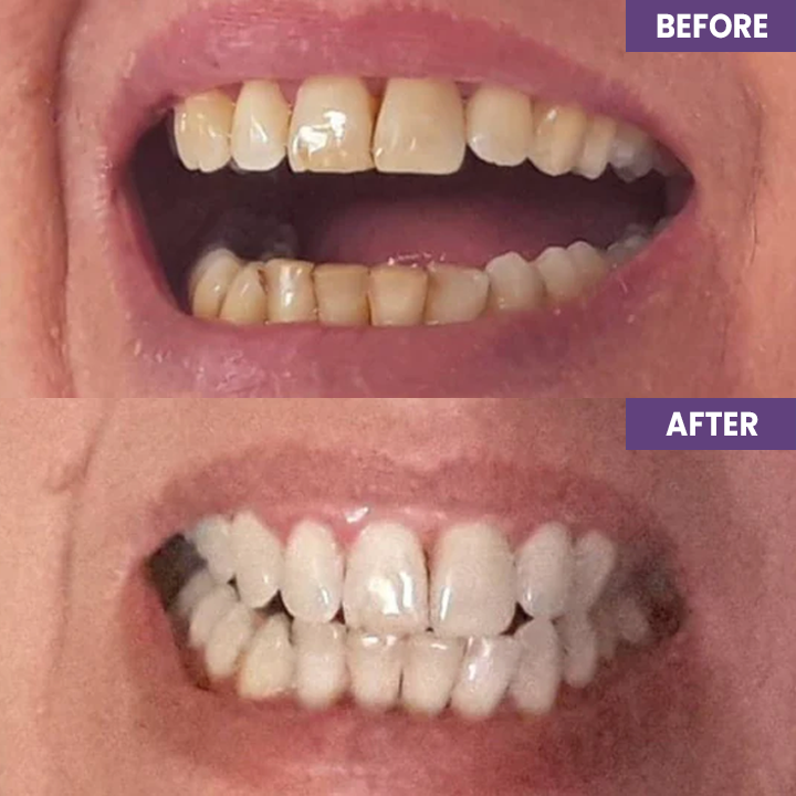 Last Day Discount ⏳LIMETOW™ Instant Teeth Whitening Paint: Smile Confidently🌟