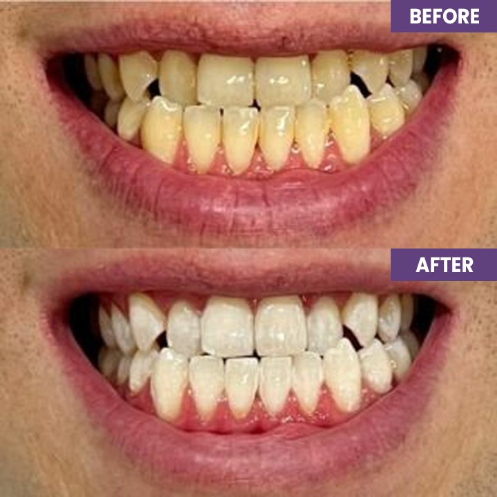 Last Day Discount ⏳LIMETOW™ Instant Teeth Whitening Paint: Smile Confidently🌟
