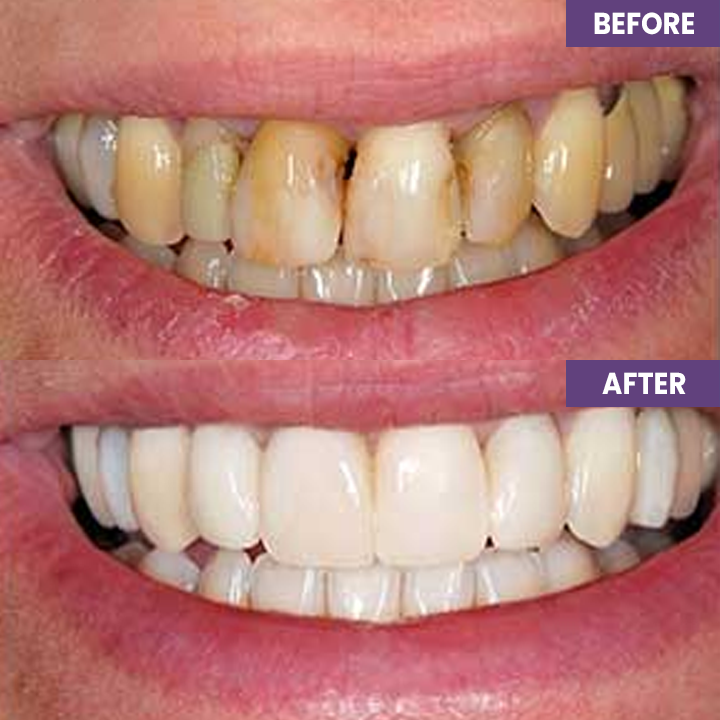 Last Day Discount ⏳LIMETOW™ Instant Teeth Whitening Paint: Smile Confidently🌟