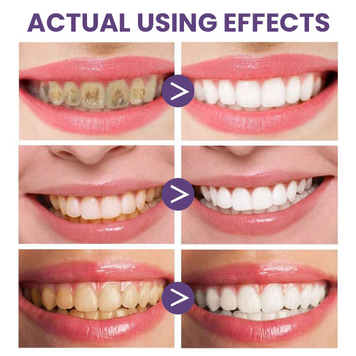 Last Day Discount ⏳LIMETOW™ Instant Teeth Whitening Paint: Smile Confidently🌟