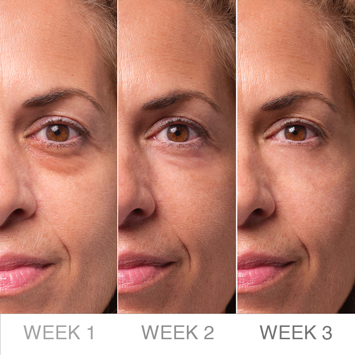 ⏰Limited Time Offer⏰LIMETOW™ Under Eye Puffiness Remover