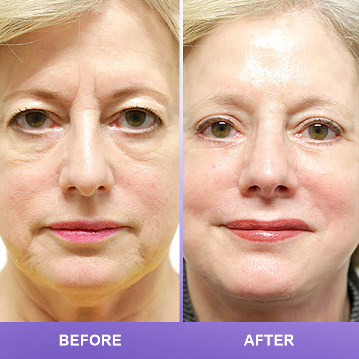 ⏰Limited Time Offer⏰LIMETOW™ Double Eyelid Cream