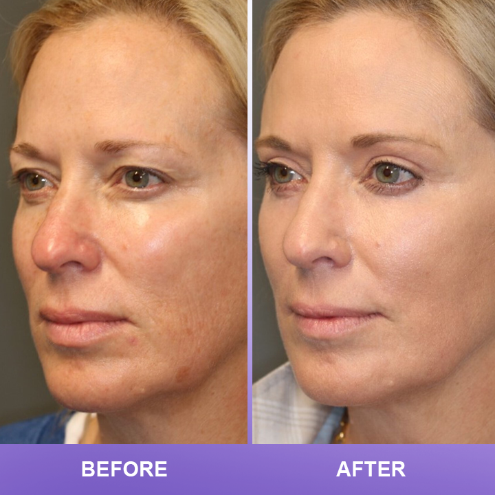 ⏰Limited Time Offer⏰LIMETOW™ Double Eyelid Cream
