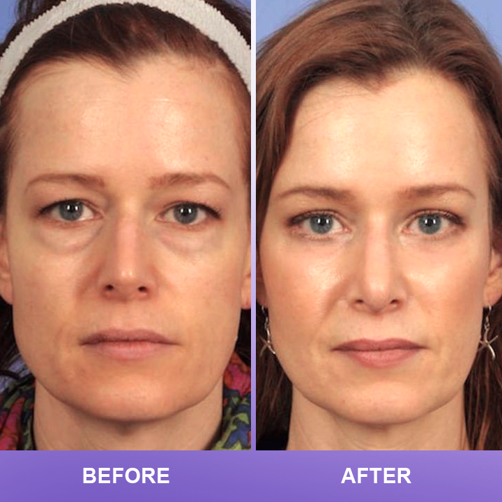 ⏰Limited Time Offer⏰LIMETOW™ Double Eyelid Cream