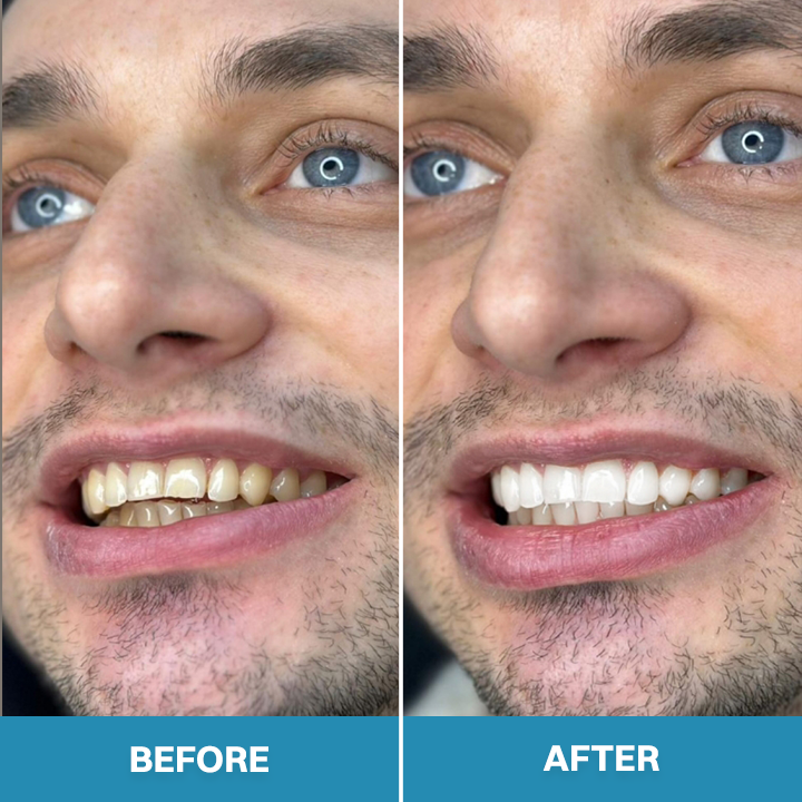 LIMETOW® Teeth Whitening Essence