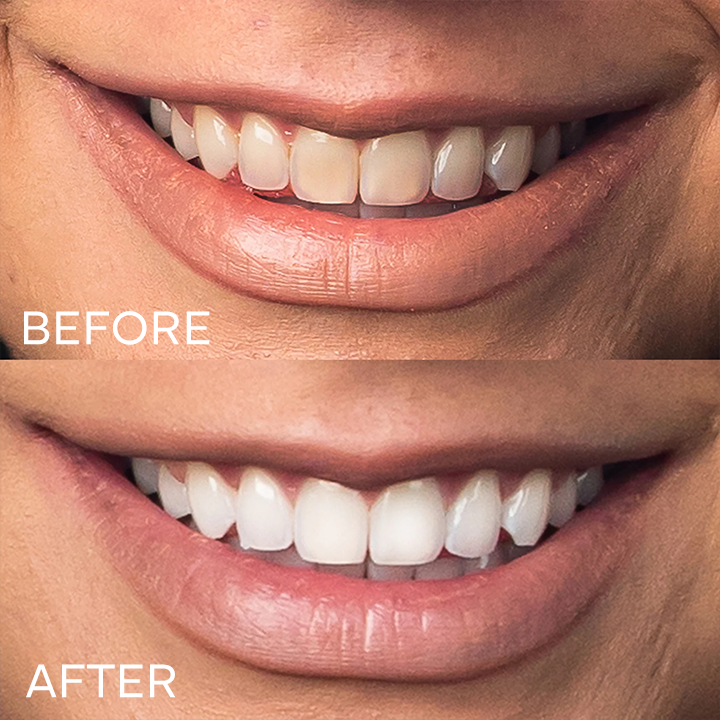 LIMETOW® Teeth Whitening Essence