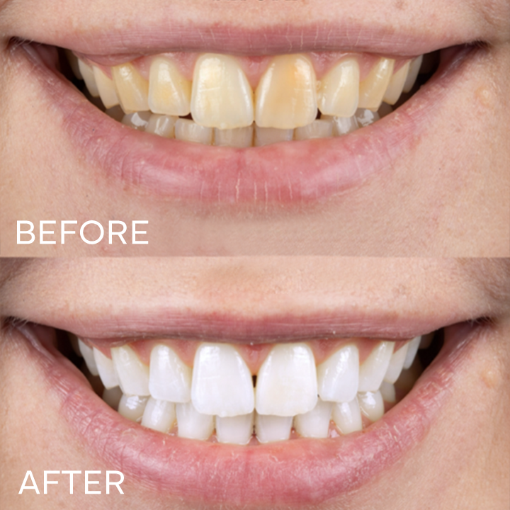 LIMETOW® Teeth Whitening Essence