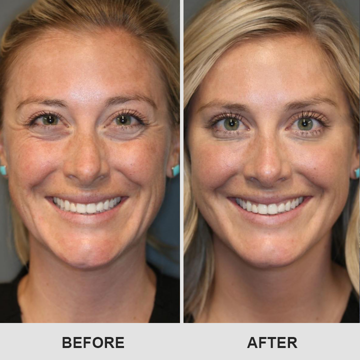 LIMETOW® Retinol Eye Stick