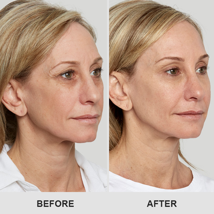 LIMETOW® Retinol Eye Stick