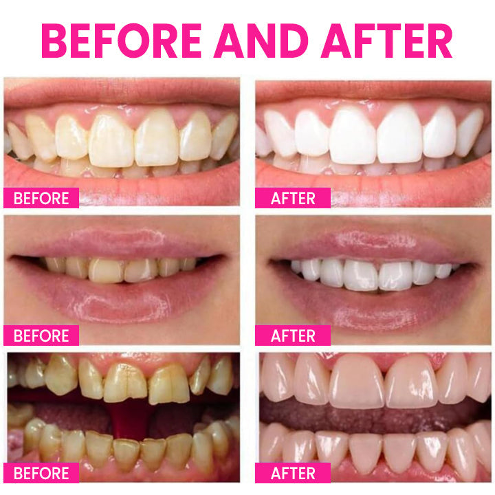 LIMETOW™ Teeth Whitening Pen
