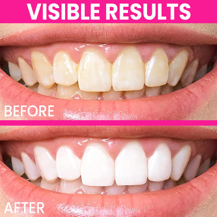 LIMETOW™ Teeth Whitening Pen