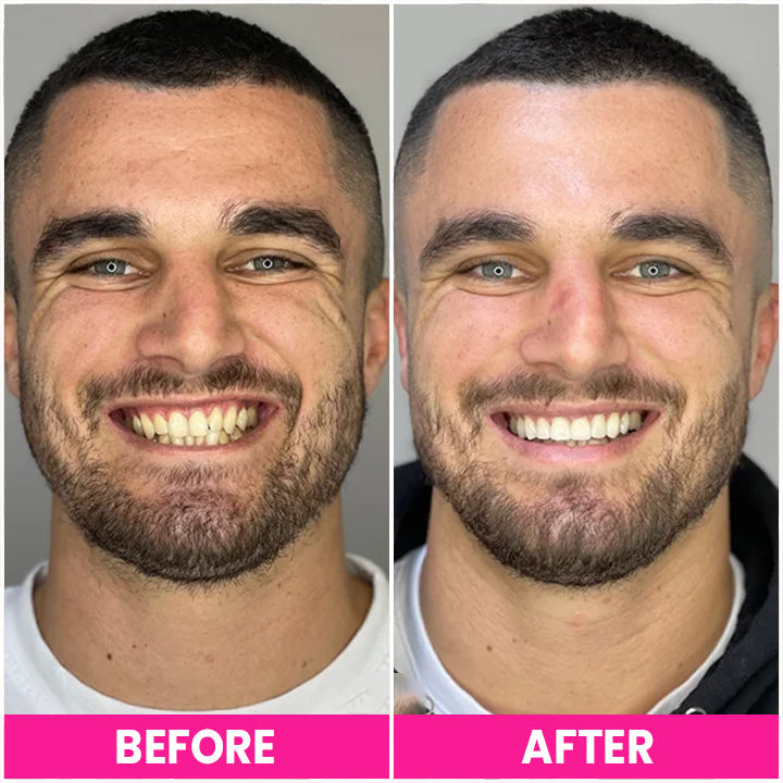 LIMETOW™ Teeth Whitening Pen