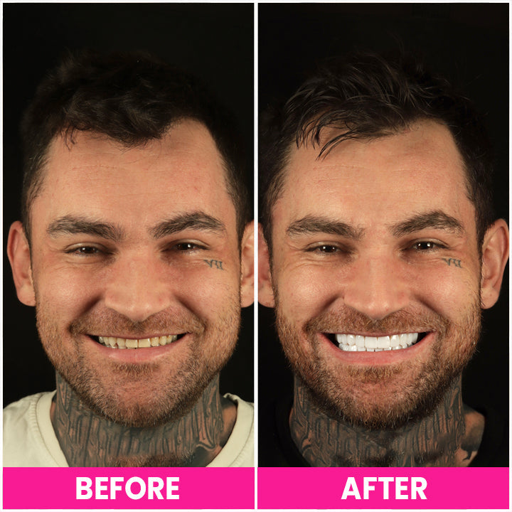 LIMETOW™ Teeth Whitening Pen