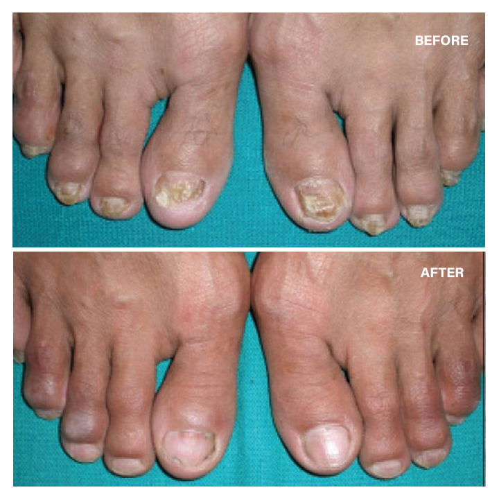 LIMETOW™ Ginger Nail Essence