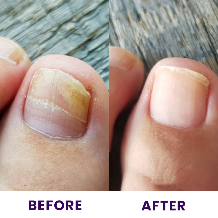 LIMETOW™🔥 Multi-Purpose Nail Repair 🔥