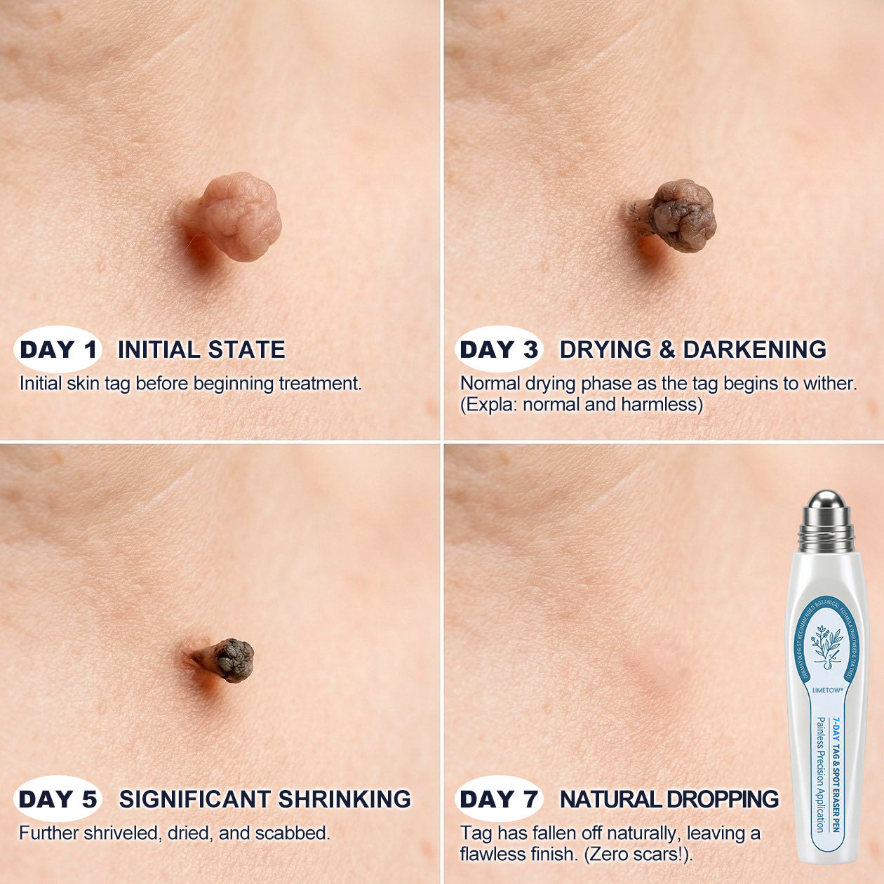 Limited-Time Offer⚡LIMETOW® ⚡Skin Tag & Spot Eraser | Remove skin tags / age spots / dark pigmentation / stubborn skin concerns / raised skin growths / small neck bumps…