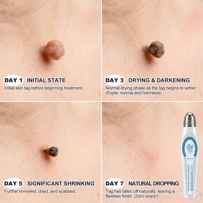 Limited-Time Offer⚡LIMETOW® ⚡Skin Tag & Spot Eraser | Remove skin tags / age spots / dark pigmentation / stubborn skin concerns / raised skin growths / small neck bumps…