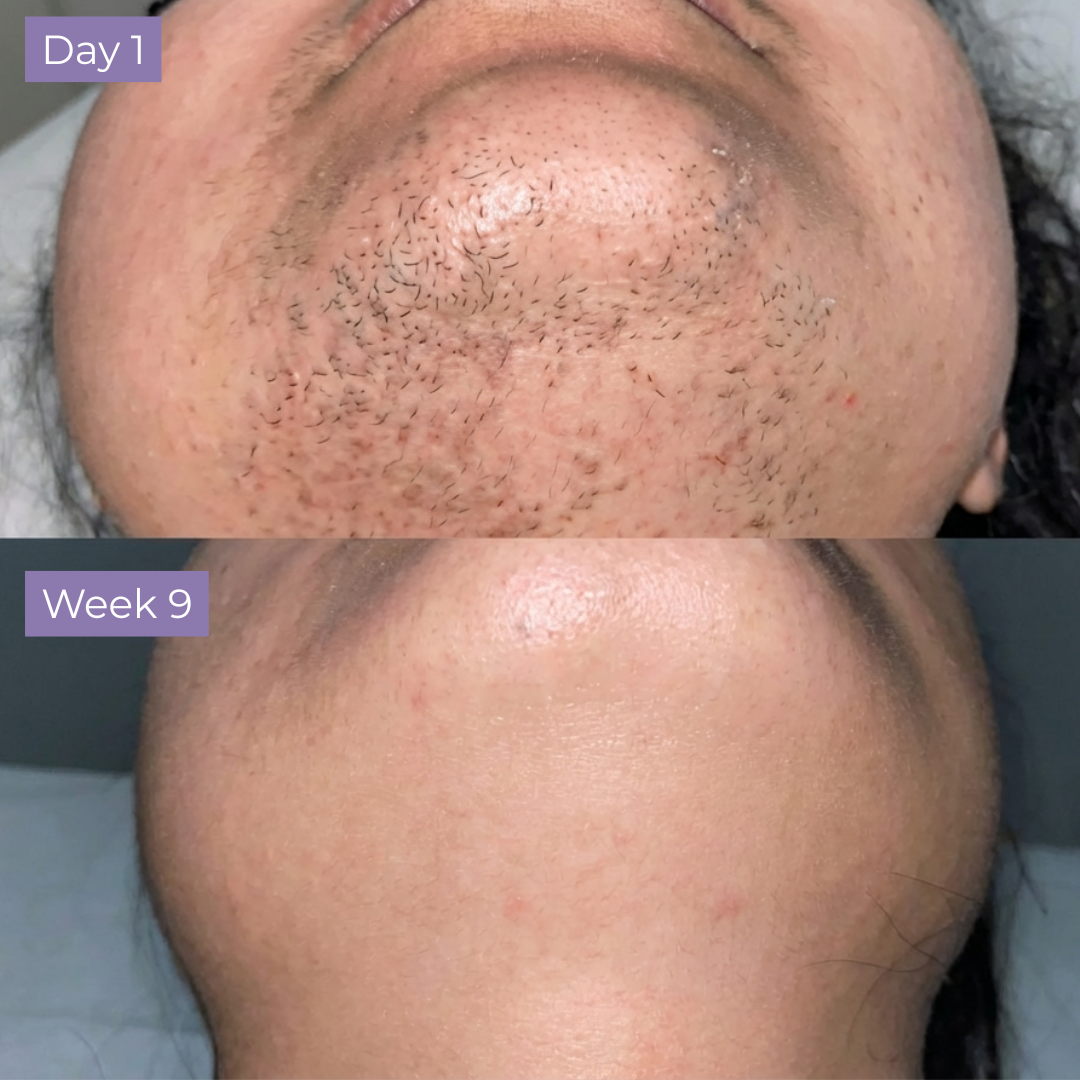 Cyperus Rotundus Skin Serum
