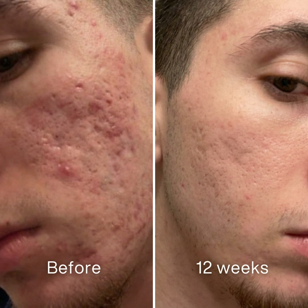 Clinical Acne Scar Repair Stick
