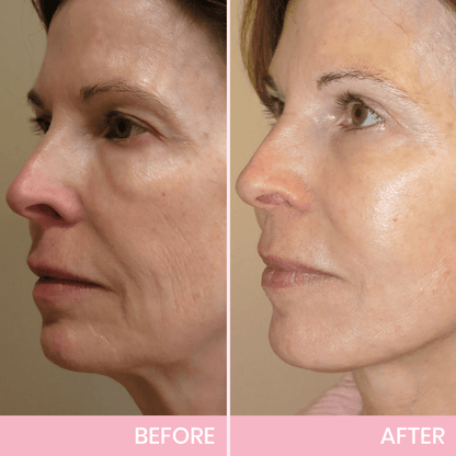 ✨ Invisible Face Lift Tape 💖 Instantly Sculpt Your Jawline & Hide Double Chin
