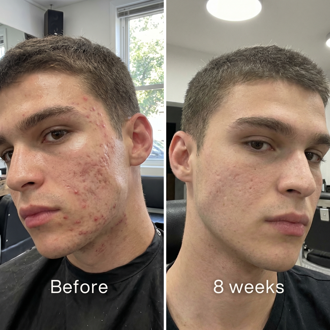 Clinical Acne Scar Repair Stick
