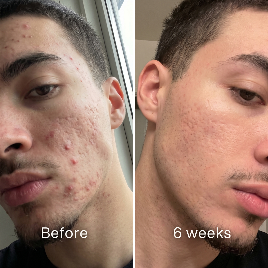 Clinical Acne Scar Repair Stick