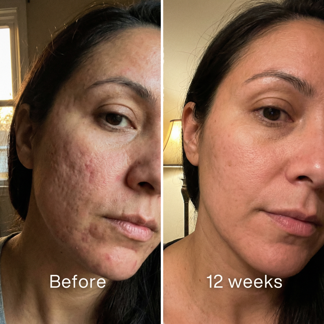 Clinical Acne Scar Repair Stick