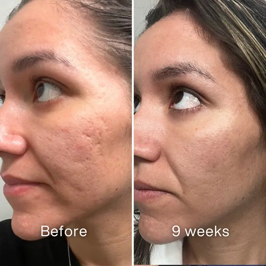 Clinical Acne Scar Repair Stick