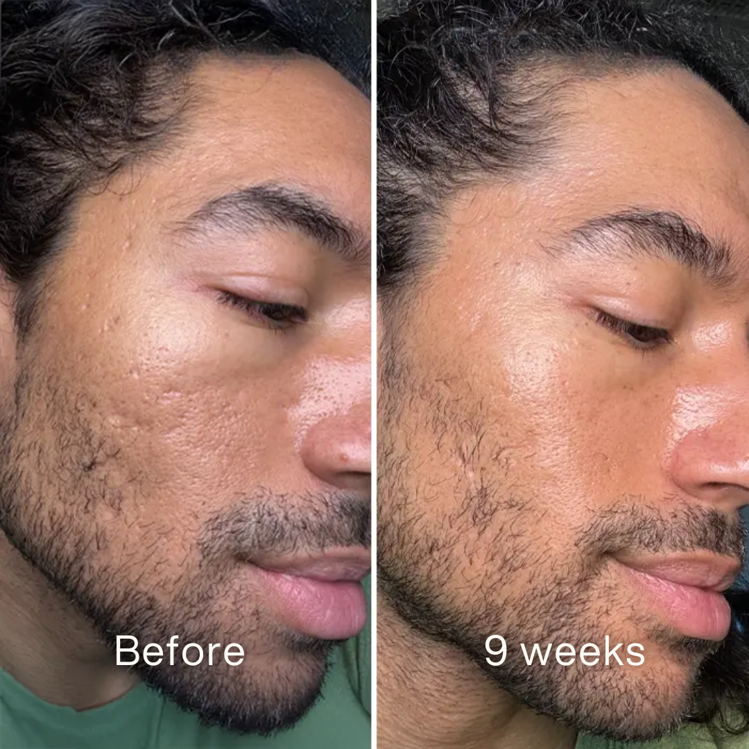 Clinical Acne Scar Repair Stick