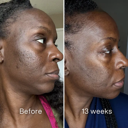 Clinical Acne Scar Repair Stick