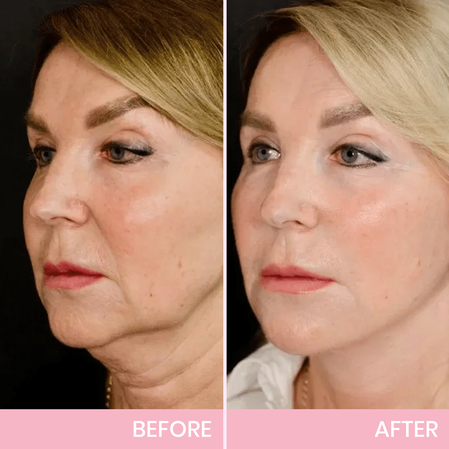 ✨ Invisible Face Lift Tape 💖 Instantly Sculpt Your Jawline & Hide Double Chin