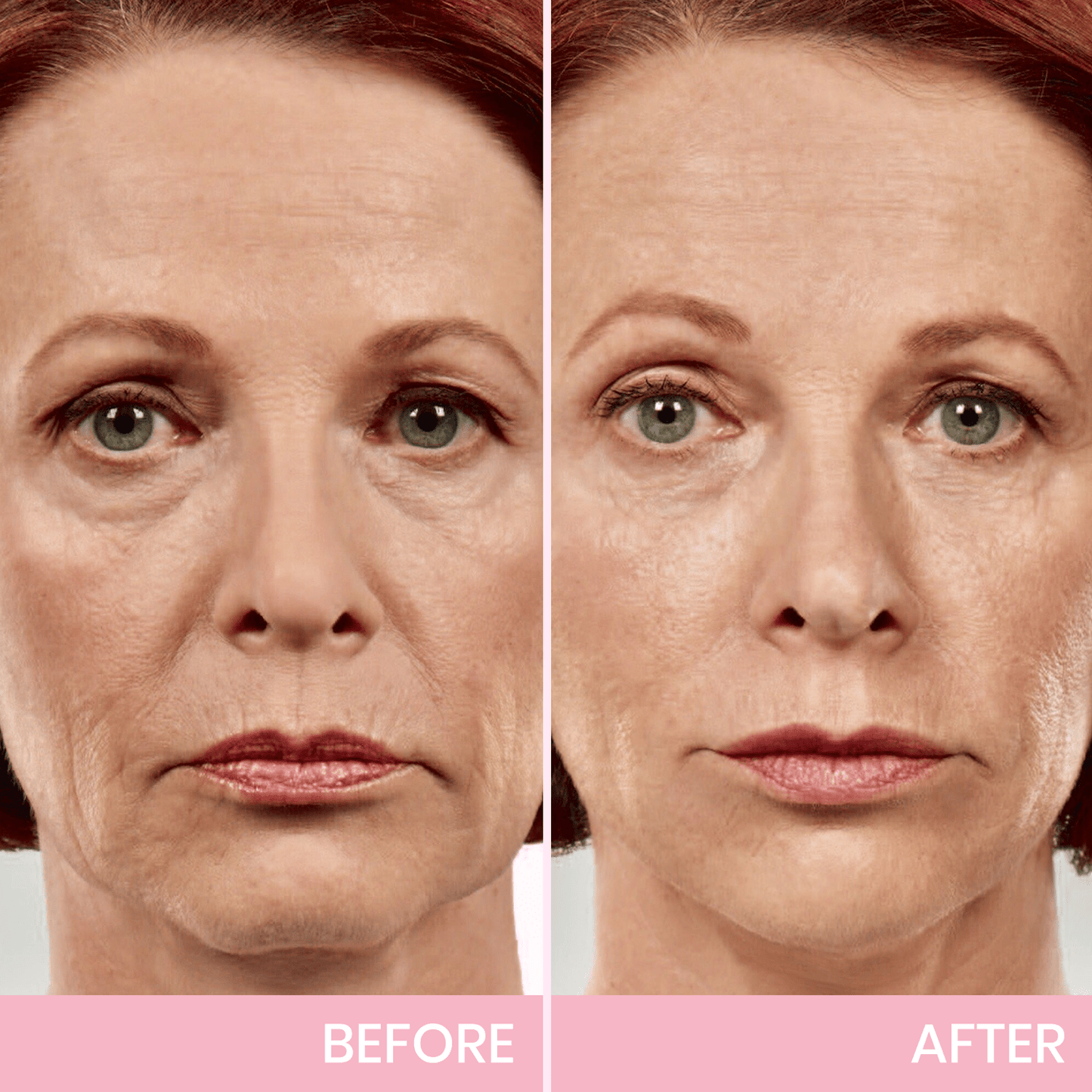 ✨ Invisible Face Lift Tape 💖 Instantly Sculpt Your Jawline & Hide Double Chin