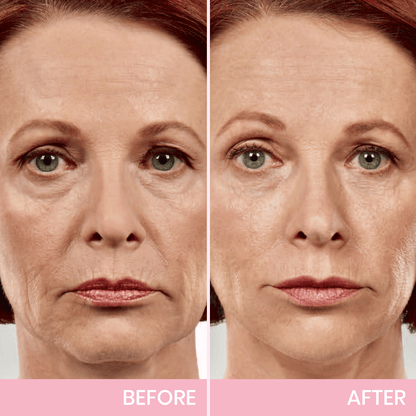 ✨ Invisible Face Lift Tape 💖 Instantly Sculpt Your Jawline & Hide Double Chin