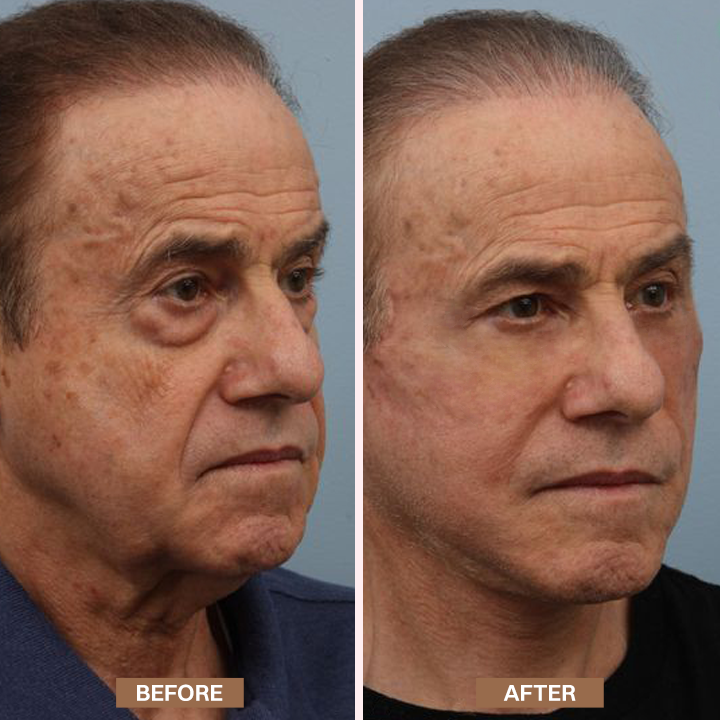 LIMETOW® Enhanse Under Eye Gel