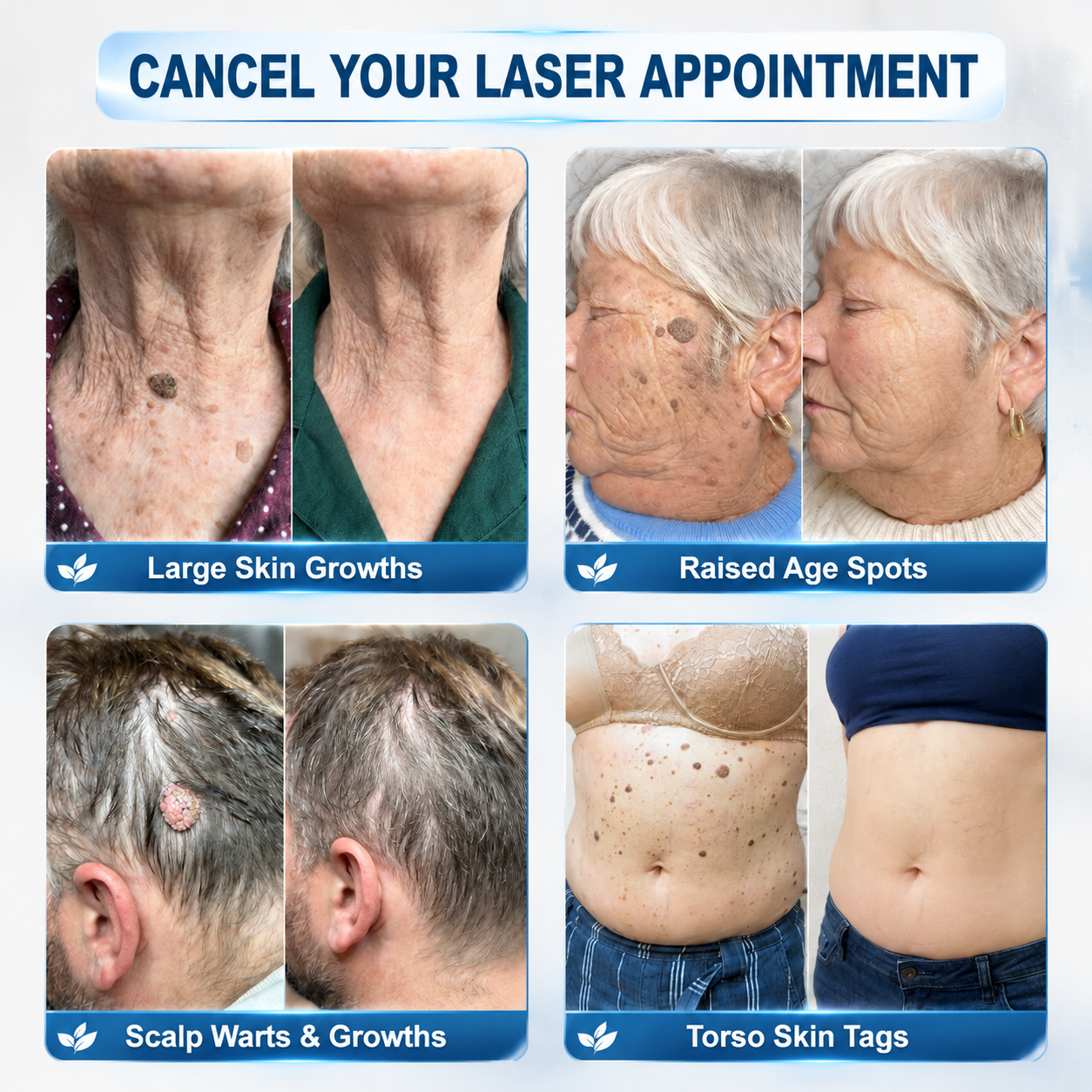 Limited-Time Offer⚡LIMETOW® ⚡Skin Tag & Spot Eraser | Remove skin tags / age spots / dark pigmentation / stubborn skin concerns / raised skin growths / small neck bumps…