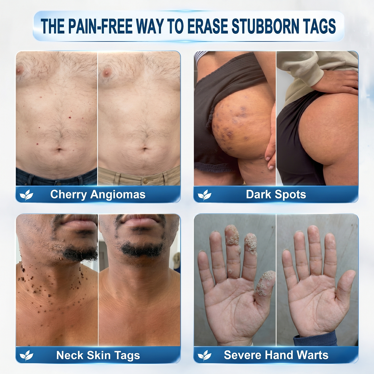 Limited-Time Offer⚡LIMETOW® ⚡Skin Tag & Spot Eraser | Remove skin tags / age spots / dark pigmentation / stubborn skin concerns / raised skin growths / small neck bumps…