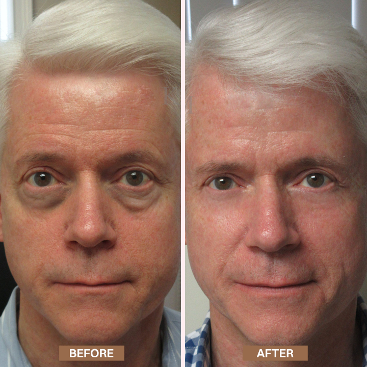 LIMETOW® Enhanse Under Eye Gel