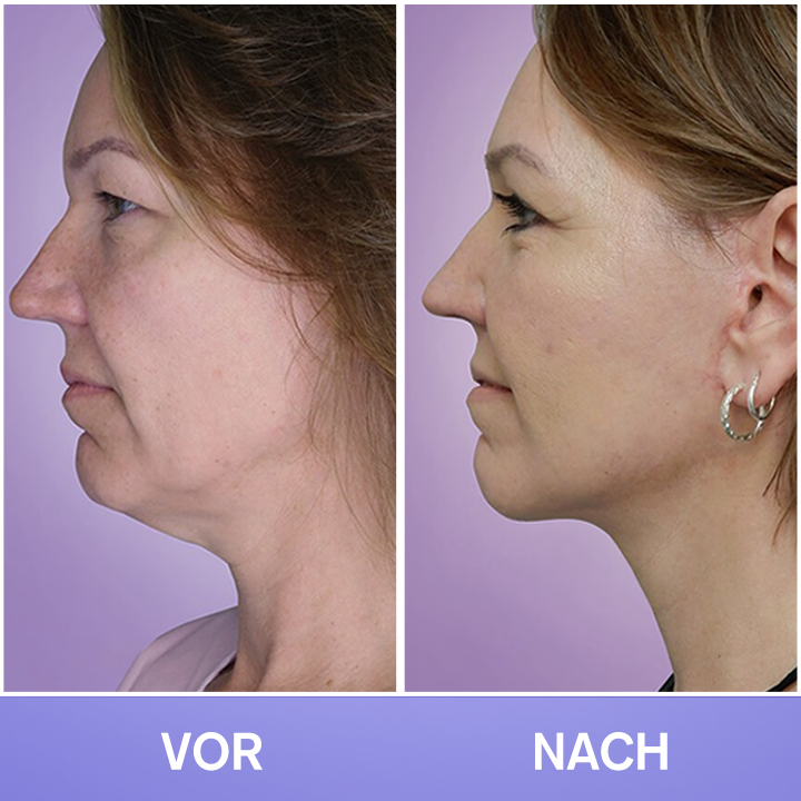 LIMETOW® Tighten & Lift Neck Cream 🔥New Product Discounts🔥 Last Day✨