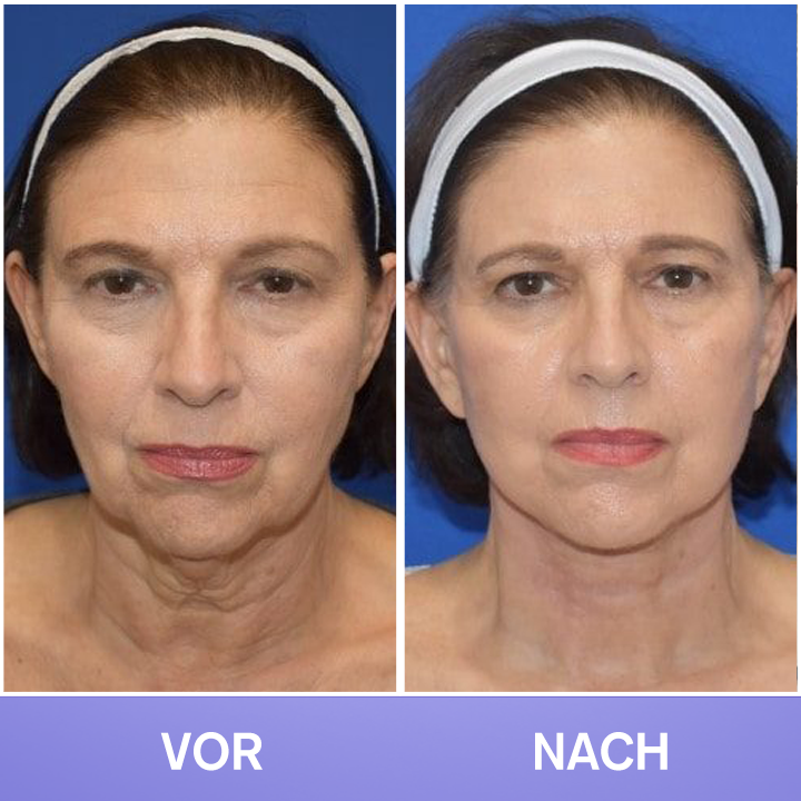 LIMETOW® Tighten & Lift Neck Cream 🔥New Product Discounts🔥 Last Day✨