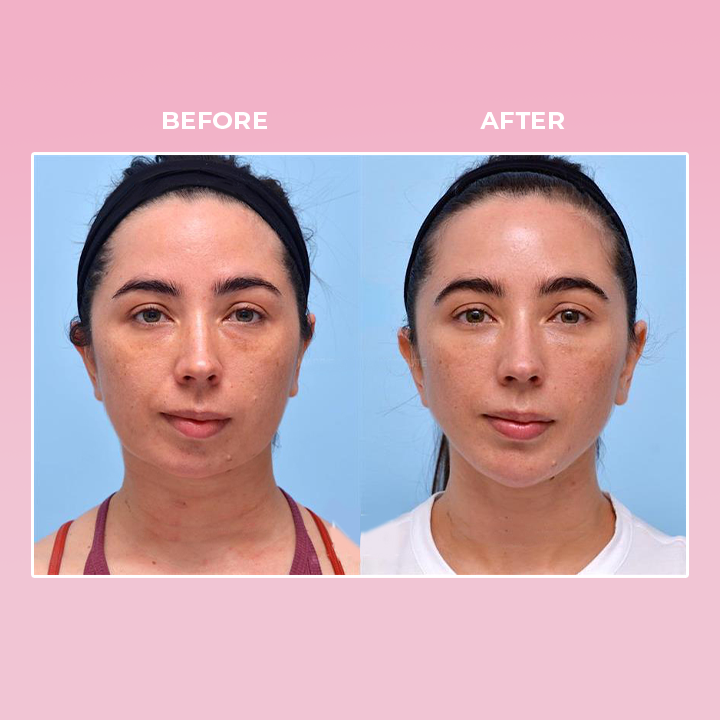 LIMETOW™ V Face Suction Trainer