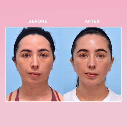 LIMETOW™ V Face Suction Trainer