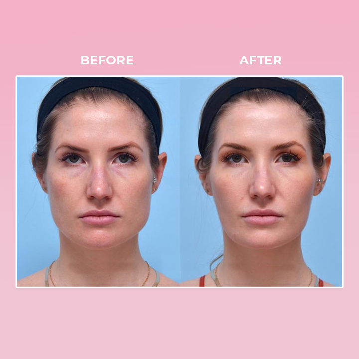 LIMETOW™ V Face Suction Trainer